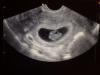 Развитие эмбриона по дням и неделям В 2 месяца беременности какие ощущения